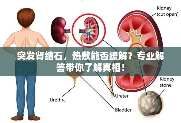 突发肾结石，热敷能否缓解？专业解答带你了解真相！